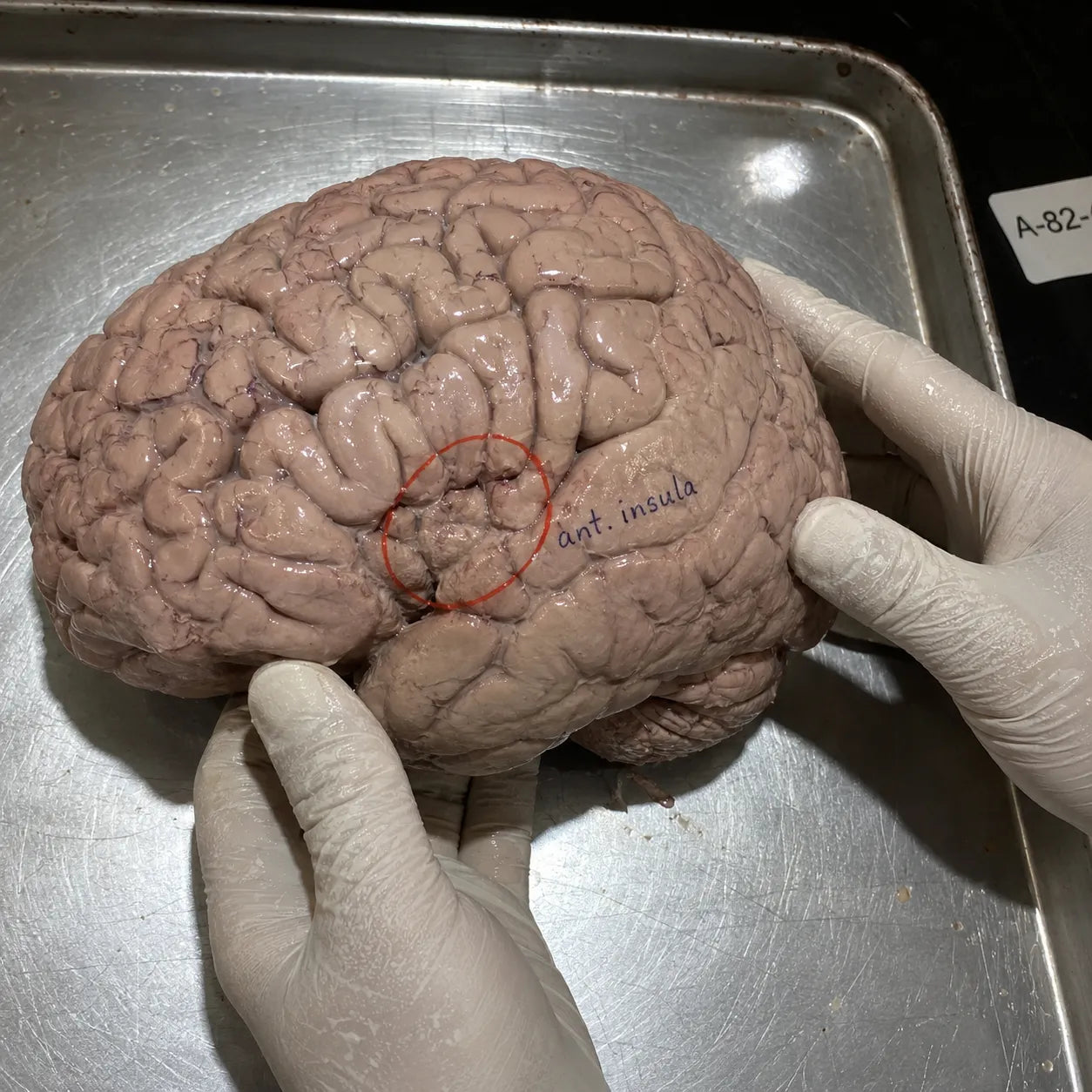 Human brain held by gloved hands on a metallic tray